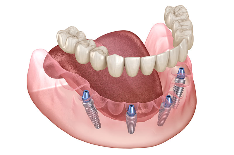 Full Mouth Dental Implants in Milford