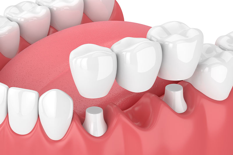 Dental Implant Surgeon in Milford