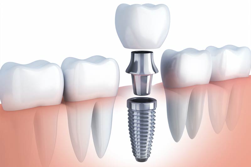 Dental Implant Surgeon in Milford